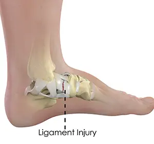 Anatomical illustration of ligament injury to the ankle with support brace labeled