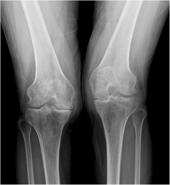 X-ray of both knees showing osteoarthritis in the joint