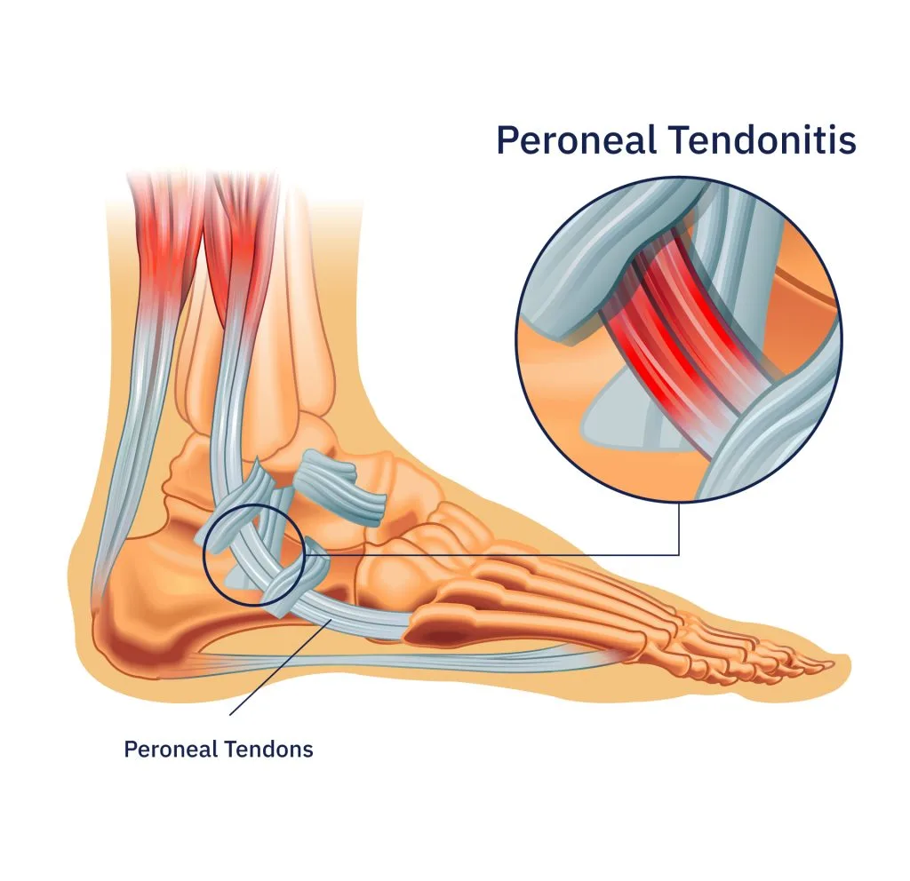 Anatomical diagram of peroneal tendonitis showing inflamed tendons in the foot and ankle